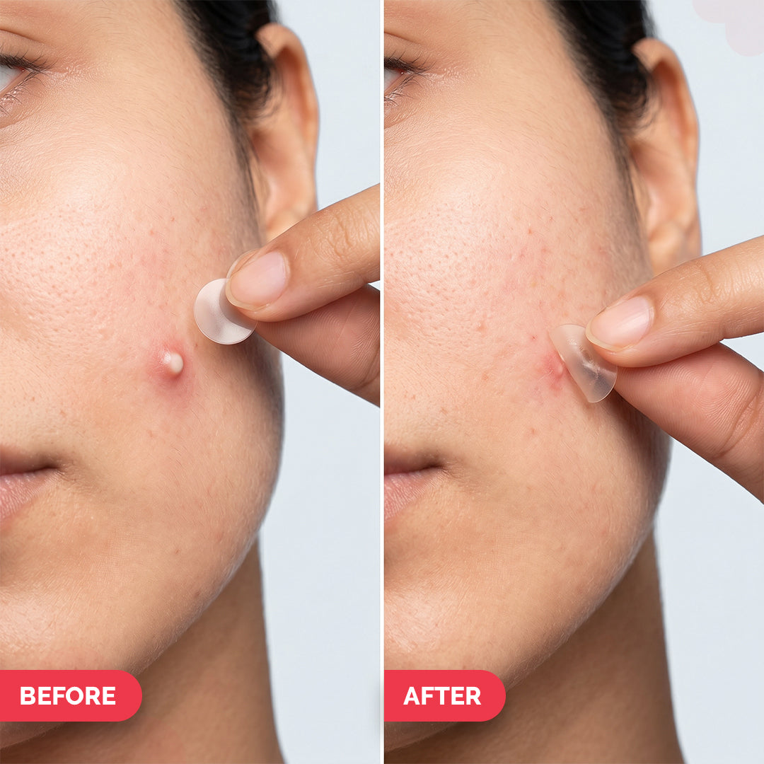 2% Sali-Cinamide Hydrocolloid Acne Patches - 36 Patches
