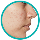 Oily and acne-prone skin