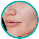 Oily and acne-prone skin