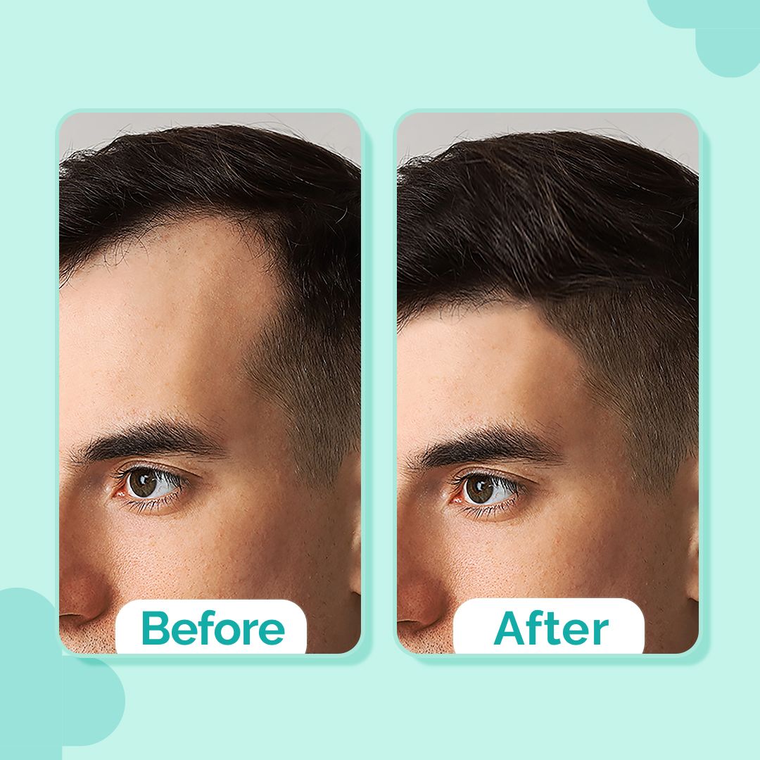 20% Actives Peptide-Stem Cell Hair Growth Serum with Foligen Analupe & Anagain For Hair Growth - 30 ml