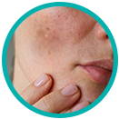 Oily and acne-prone skin